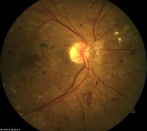 Photograph of the retina with diabetic retinopathy