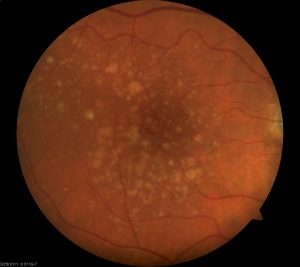 Photo of a retina with Dry Macular Degeneration