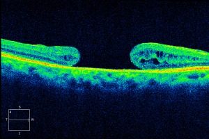 Macular Hole