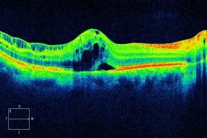 Macular Edema