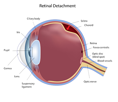 Retinal Detachment Austin, Texas