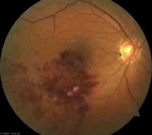 Retinal Vein Occlusion Austin, Texas