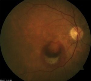 Photo of a retina with Wet Macular Degeneration